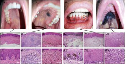 Mucosal Melanoma: Pathological Evolution, Pathway Dependency and Targeted Therapy